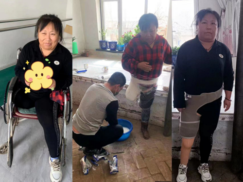 图为安装假肢前后对比图